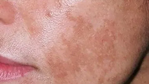 ★ Отвар из ЧИСТОТЕЛА эффективно устранит пигментные пятна, лечит разные дефекты кожи.