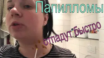 💥ПАПИЛЛОМЫ💥 как я удаляла народными средствами