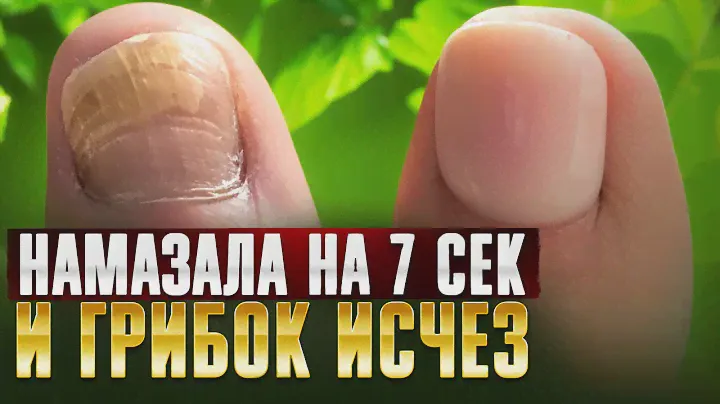 Как я навсегда уничтожила грибок ногтей! Грибок ногтей на ногах лечение в домашних условиях